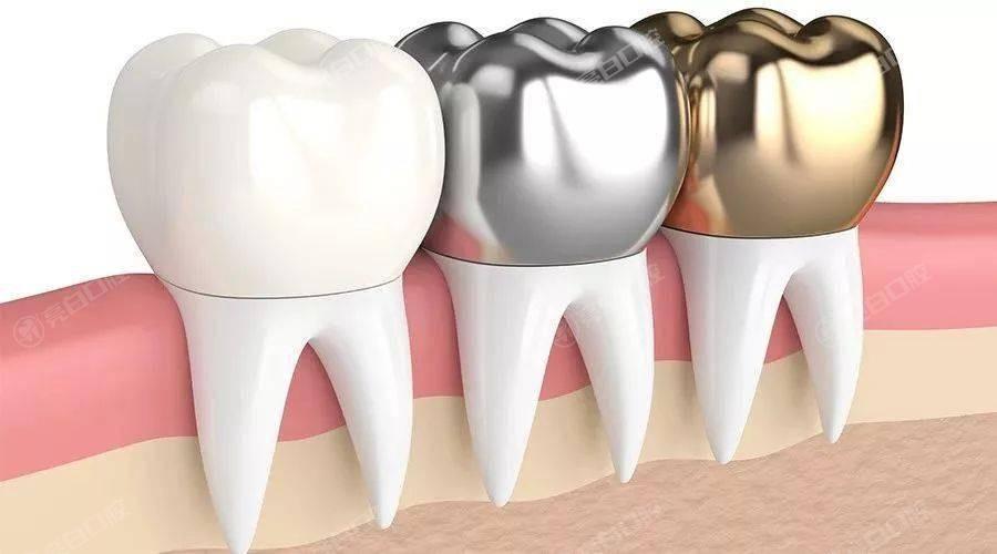 根管治療是什么？有哪些注意事項(xiàng)？